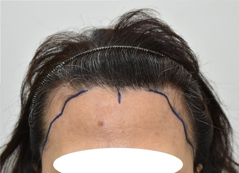 This is the review of 2000 non-excision surgery by Director Ki Sung-wan of Morbun Clinic. ^^