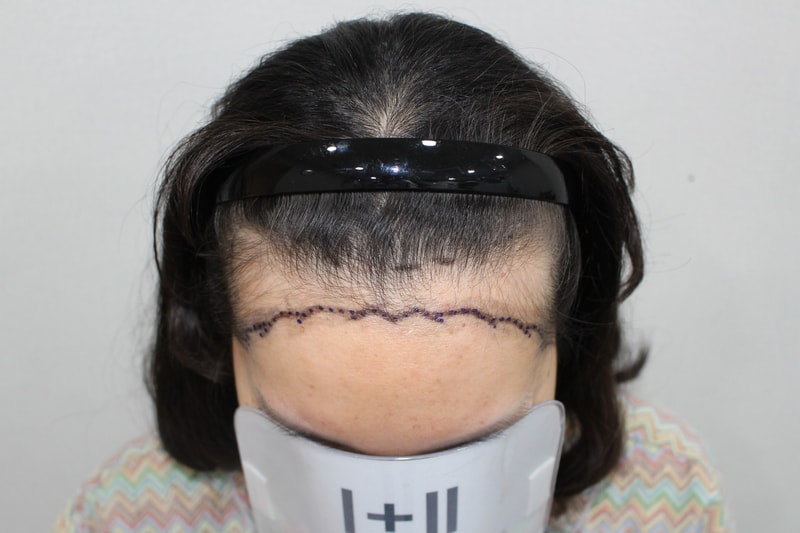 Post-mortem immediately after Moderhamm Clinic — Hair Transplant Center female m-shaped surgery