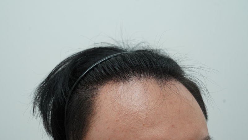 [Yeon Semona Clinic] I'm in my 20s with deep M-shaped hair loss non-cut 1500 hair follicles (3,800 hair) and I'm in my 3rd week! (Attached 7 photos)