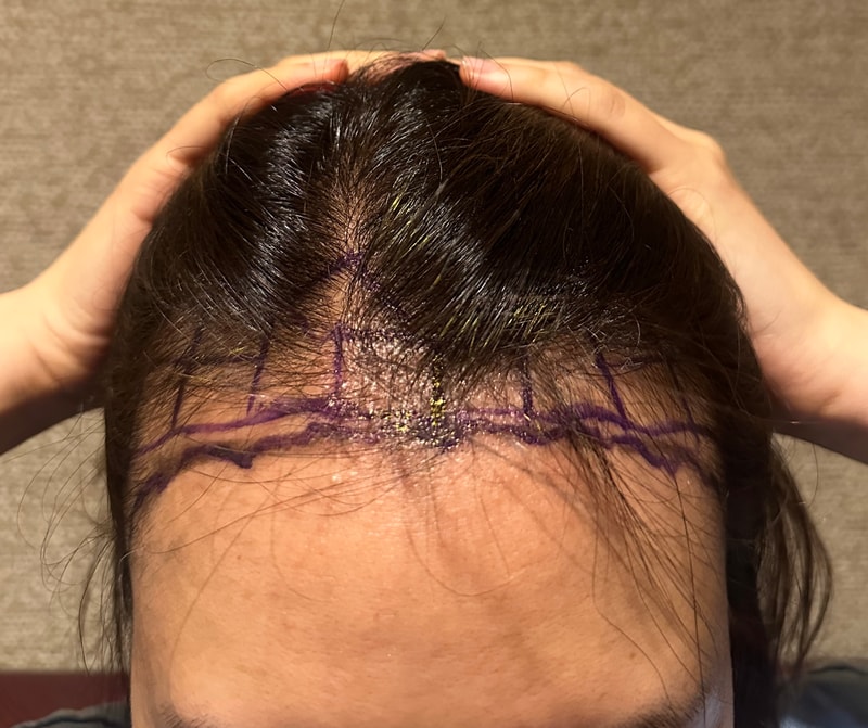 I had a 3400-mo hairline incision