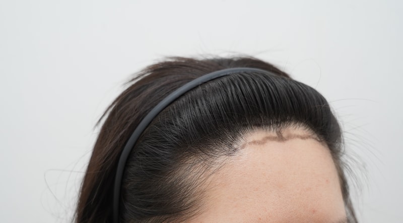 [Yeon Se-mona clinic] Get out of the center of the hairline! Did you bring the review of the 3rd week of the non-cut 500 hair follicle (1300 m) small transplant????