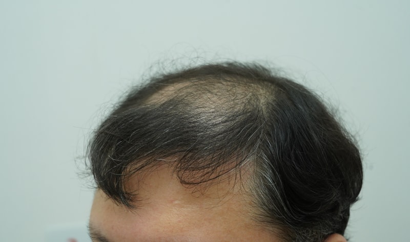 [Yeon Se-mona Clinic] It's been 3 weeks since the mass transplant between the frontal and central hair loss in their 40s.