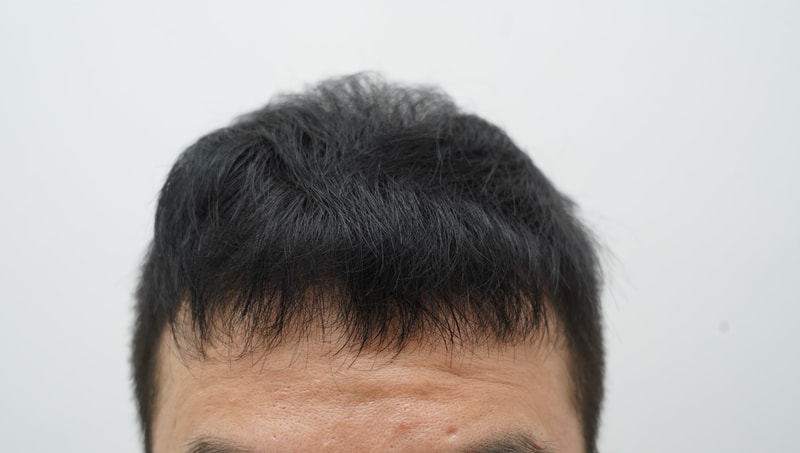 [연세모나의원]비절개 이식한 지 어느덧 9개월 차, 드디어 바람 부는 날이 두렵지 않네요. 