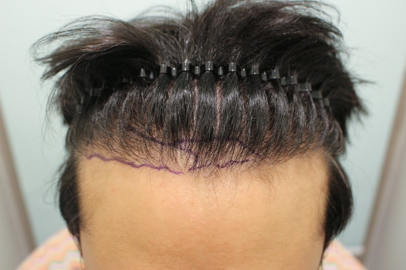 ヘアライン 植毛8か月目 | チャムドクター自毛植毛クリニック