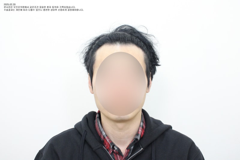 10년 전에 모발이식했는데도 M자가 남았다면, 다시 체크해야 할 부분이 있습니다