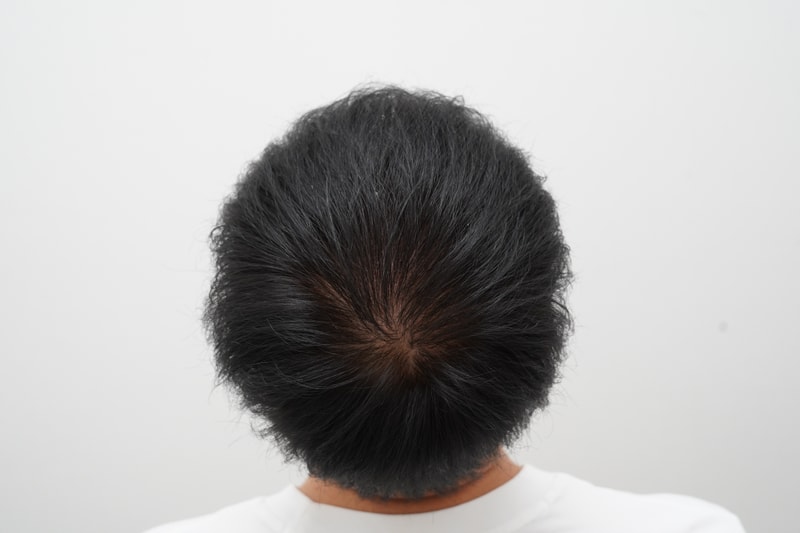 [연세모나의원] 1500모낭 비절개 정수리 이식 벌써 7개월 차 경과 공유합니다! ㅎㅎ