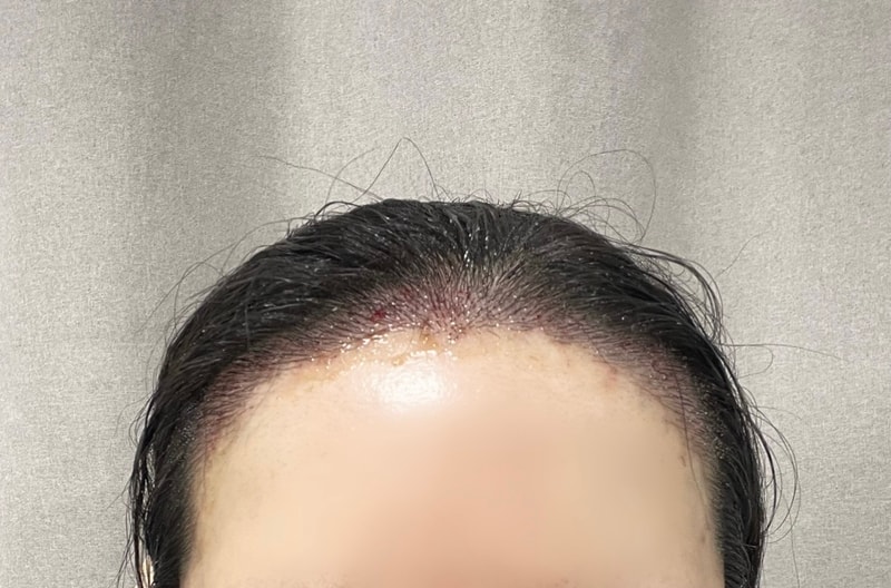 압구정 모우림의원 절개2000모 당일후기