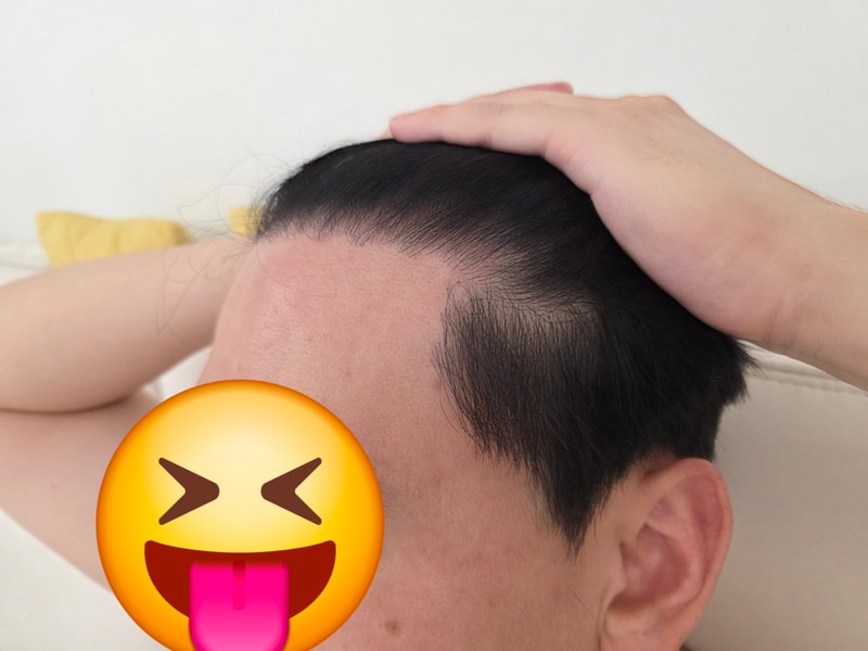 대구 더블랙성형외과 모발이식 8개월경과