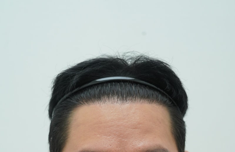 [연세모나의원] 헤어라인 7개월 차 후기