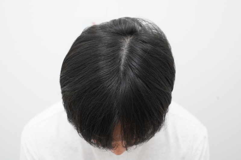 [연세모나의원] 정수리 모발이식 7개월 차 생생 후기