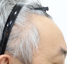 모발이식 후기 올립니다(시술 직전과 직후 사진).