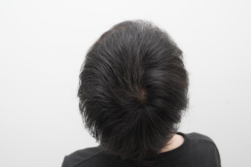 [연세모나의원]모발이식 남자 5300모 후기 11개월차