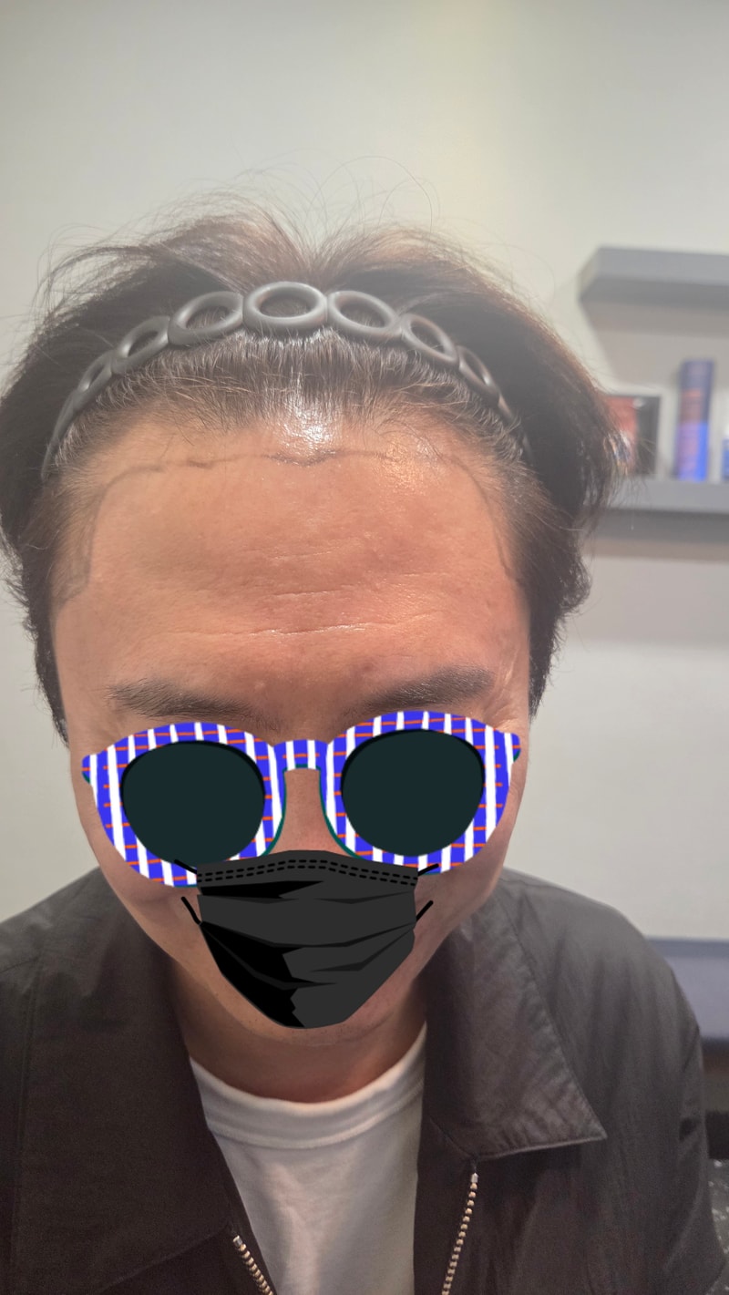 비절개 이식 4개월 후기