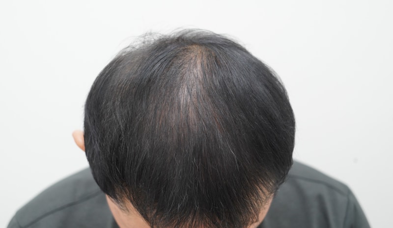 [연세모나의원]비절개모발이식 7개월차 변화 기록