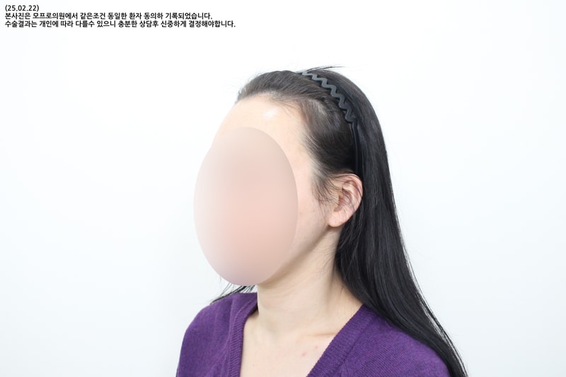여성 헤어라인, M자 이마와 모류 방향까지 함께 본 이유