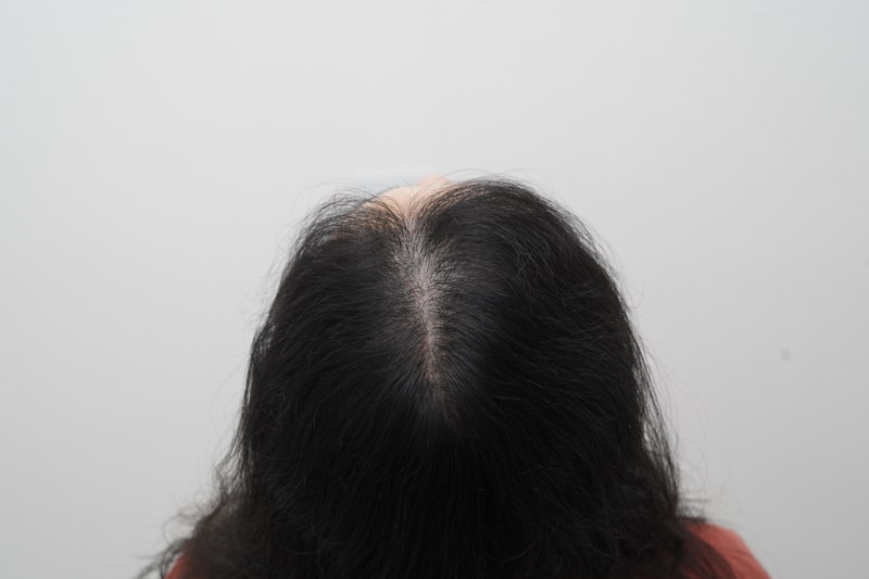 [연세모나의원] 여성 가르마 모발이식 7개월 차 솔직한 경과입니다.