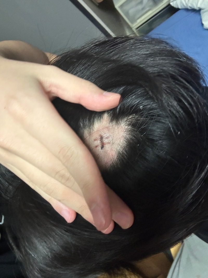 炎症除去後の薄毛の悩み