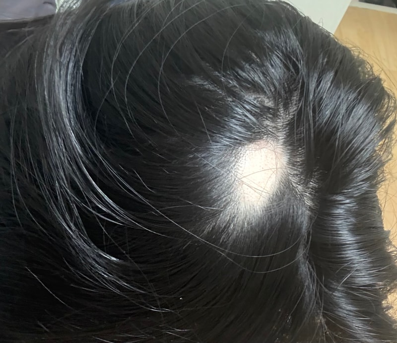 21歳女性の薄毛、これくらいでかなり進んでいるんですよね？
