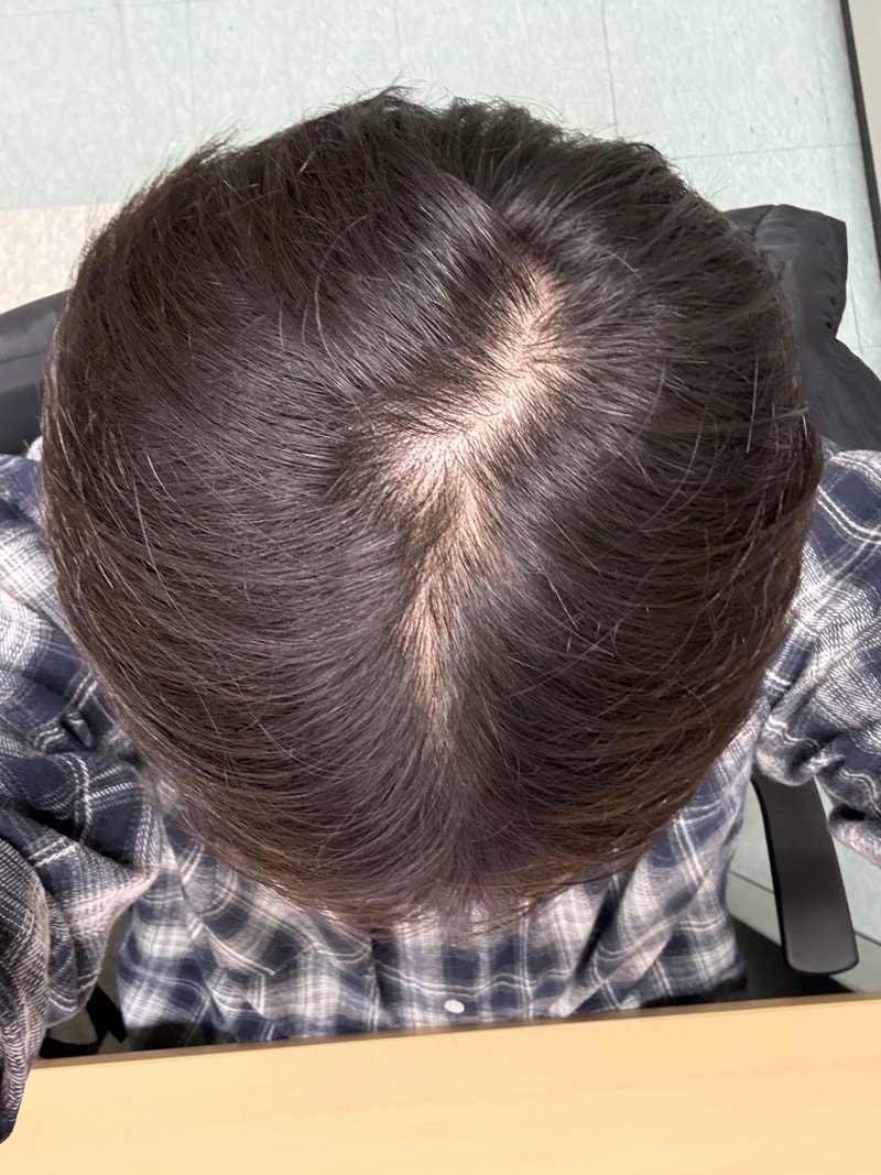 21歳の薄毛に関する質問です