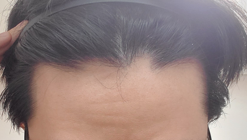 고3 탈모 맞나요..?