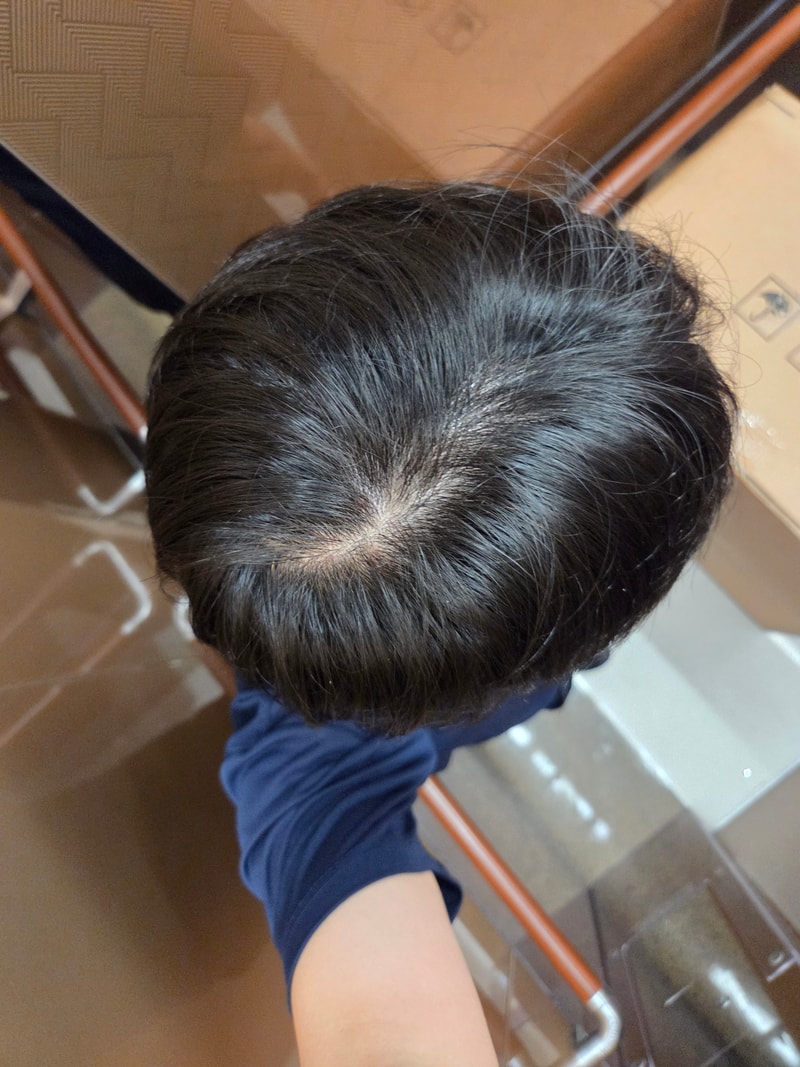 19-23세이른탈모