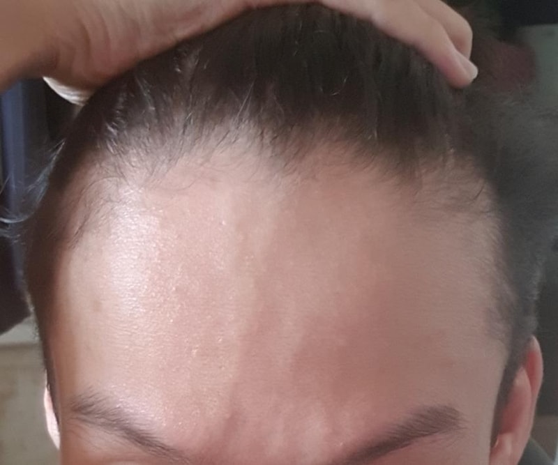 1534400203_alopecia.jpg