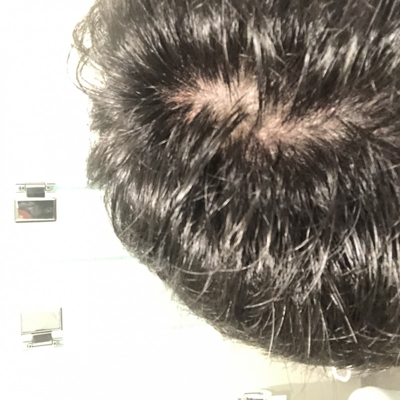 どんな薄毛だと思う？？