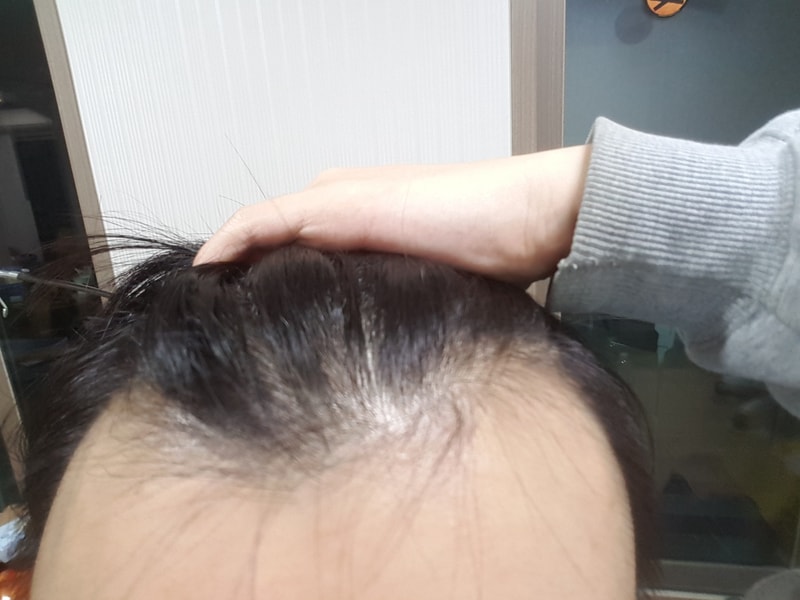저 결정했습니다~ 아직 20대 초반..