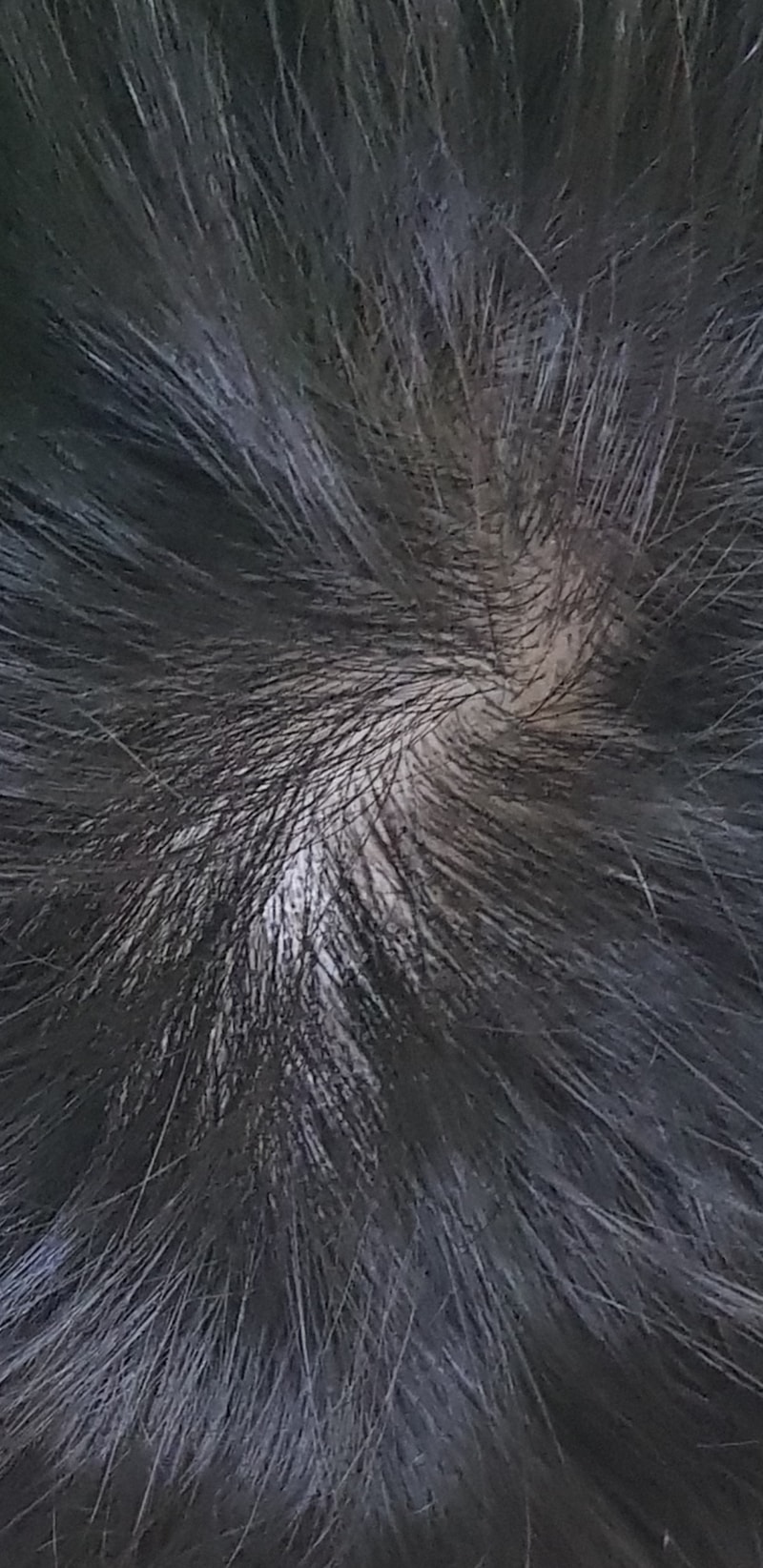 미녹 4개월차 정수리 쉐딩일까요..? 계속빠지네여ㅠㅜ