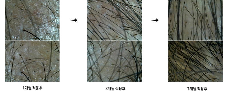 의약품이 아닌 화장품의 제품후기입니다(5번째 글, 12개월) 상품으로..