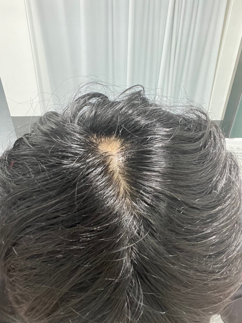 이거 남성형 탈모일까요?