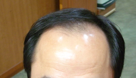 치료전.jpg