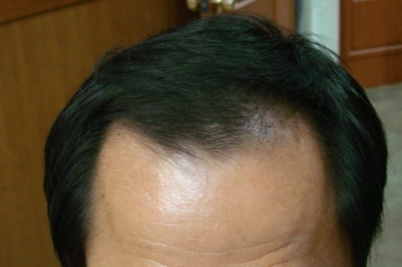 치료후.jpg
