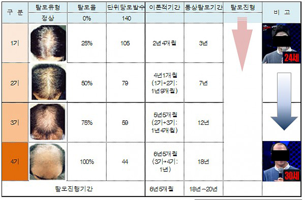 완전대머리기간.jpg