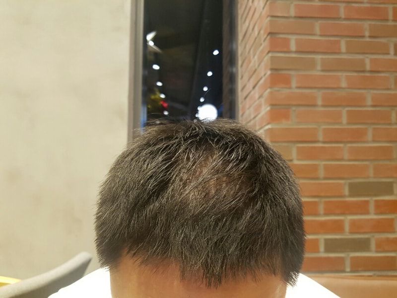 탈모.jpg