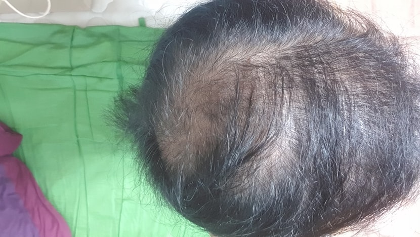 두타놀 복용 50일째