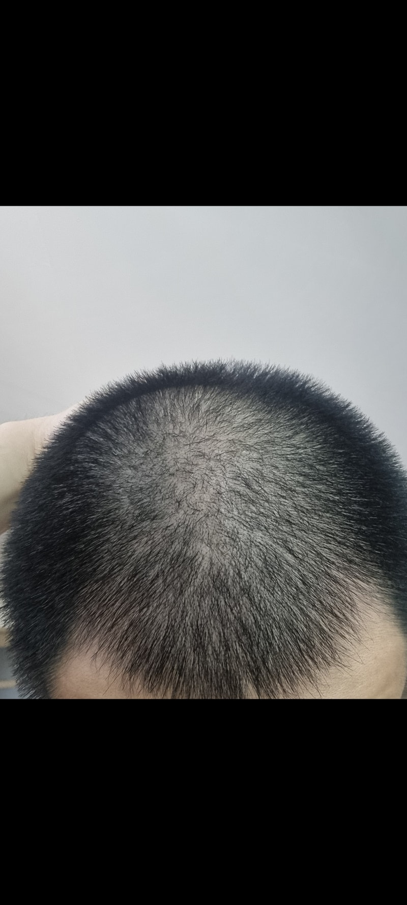오늘 병원 가서 탈모약 처방 받고 왔습니다..