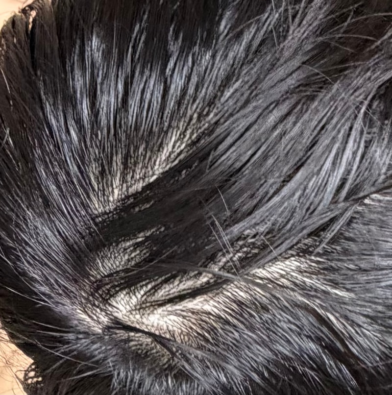 탈모약이 효과가 없을 수 있는지 