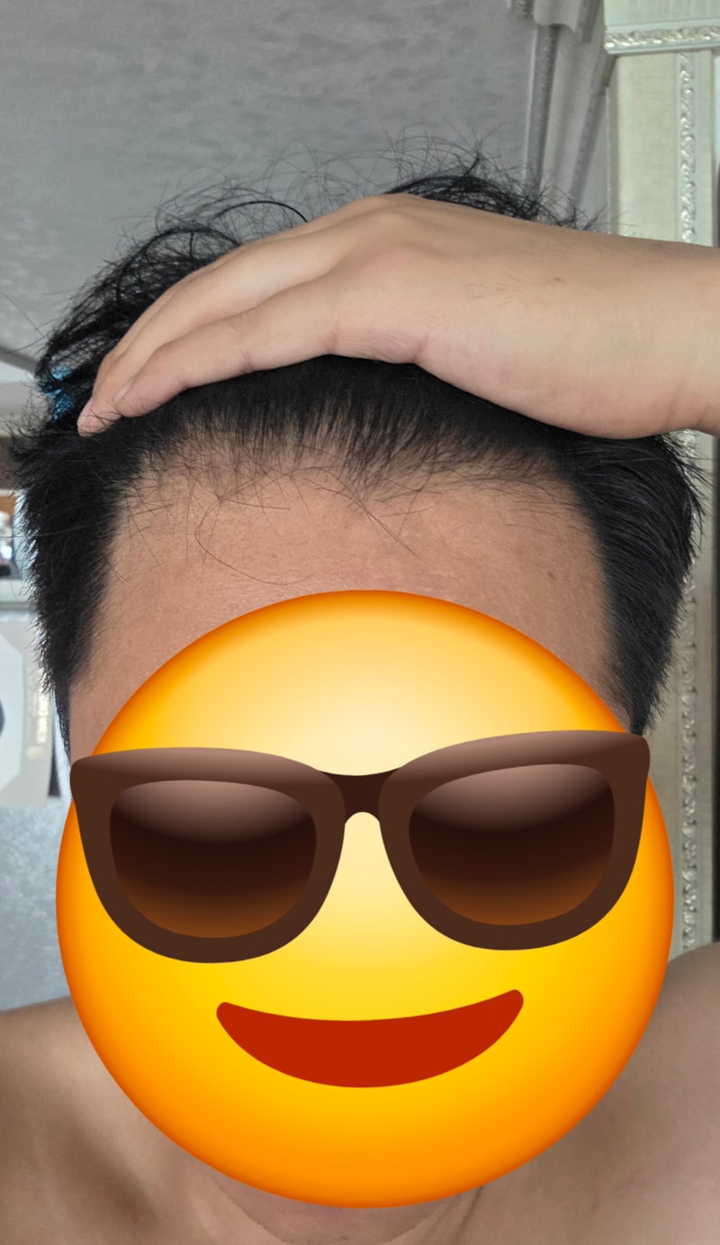탈모약 10개월차문의