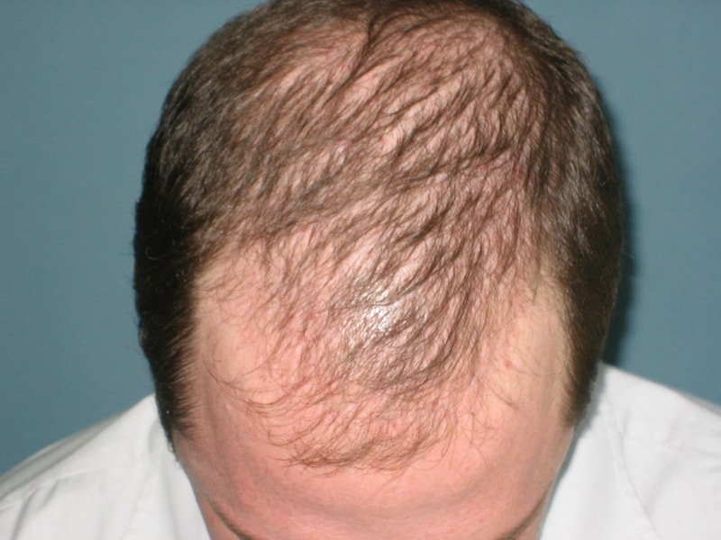 balding.jpg