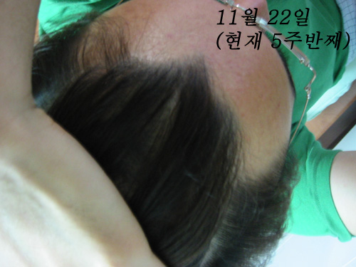 탈모1.jpg