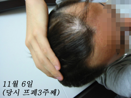 탈모2.jpg