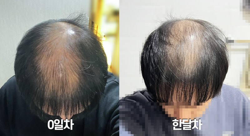 프로페시아 + 미녹시딜 한달차 후기 입니다