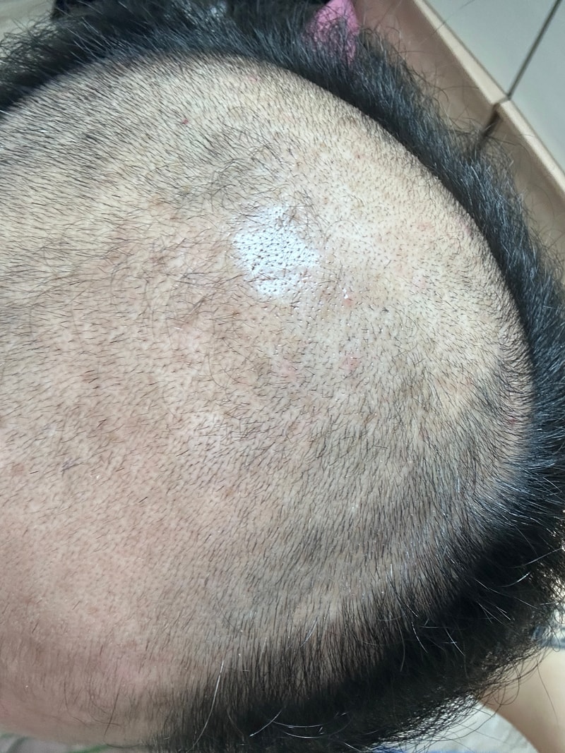AGA治療薬2か月目を少し過ぎました