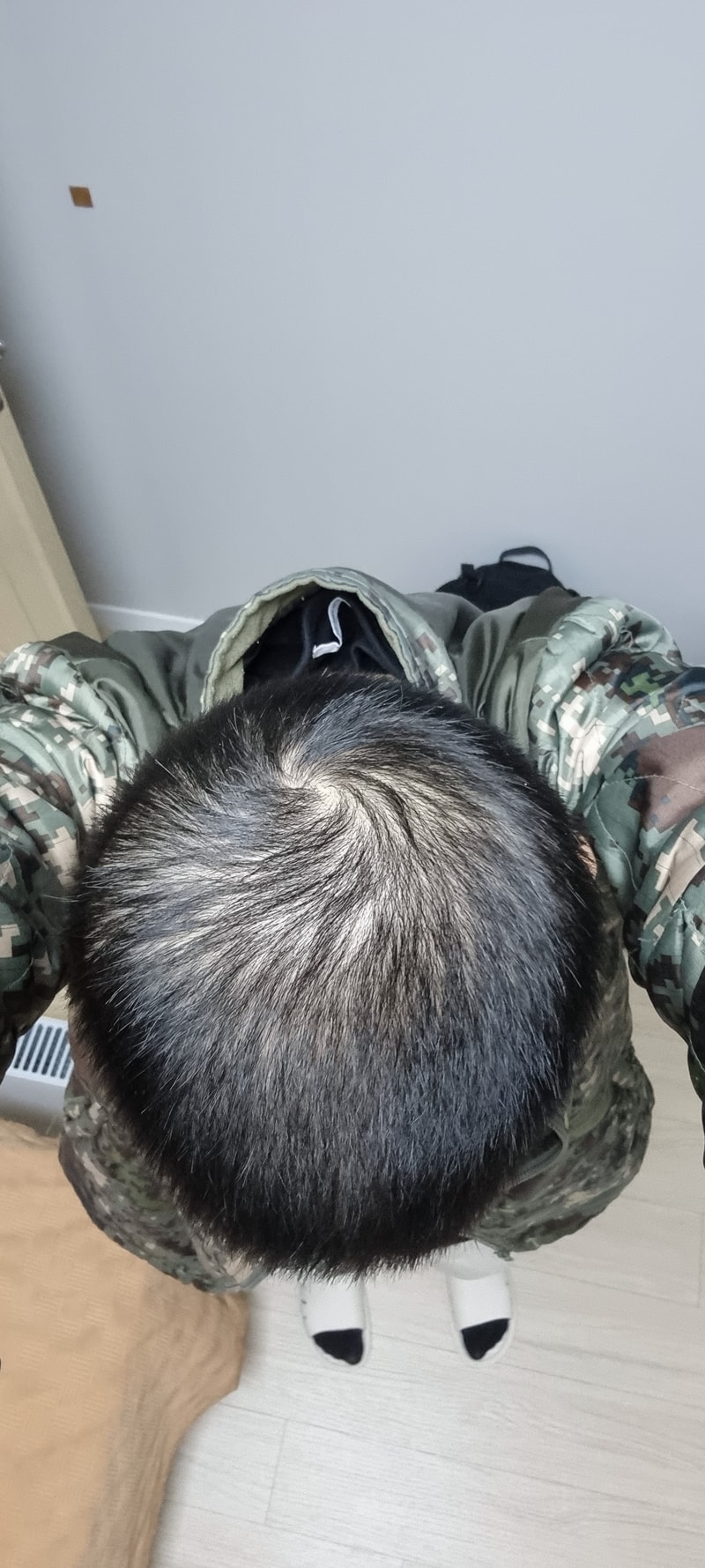 ミノキシジル＋フィナステリド 4年 体験談です..