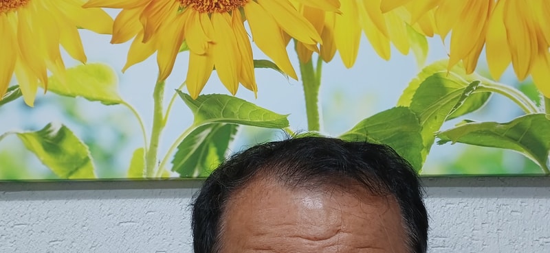 Strong effect of minoxidil pills + stevia...I strongly recommend it!