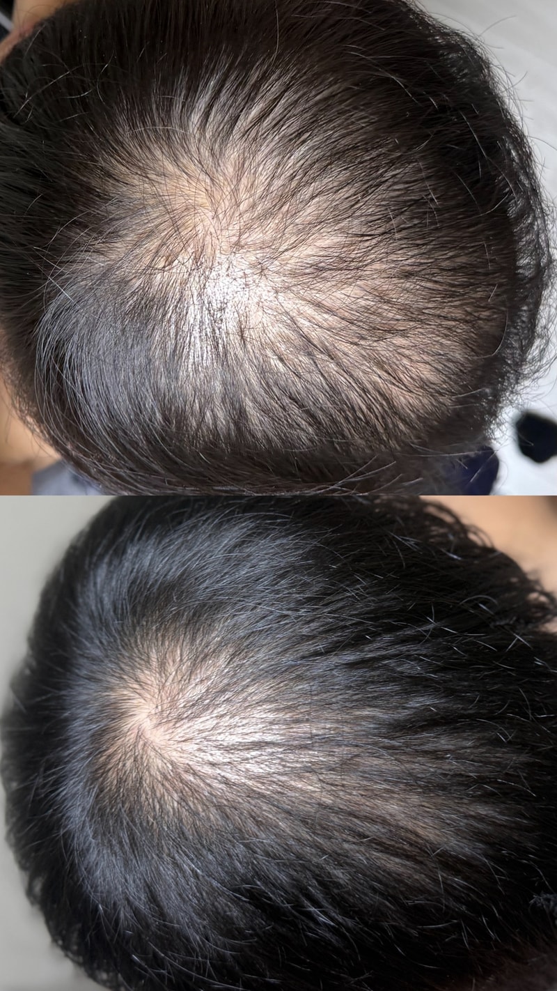 Dutasteride + minoxinyl for 5 months