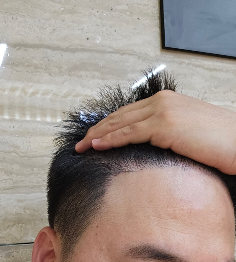 Hair loss medication Finasteride F Pecia jin review (sakuraherb)