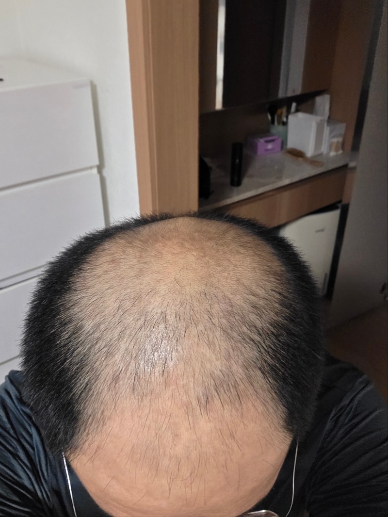 탈모약 복용 1년 6개월