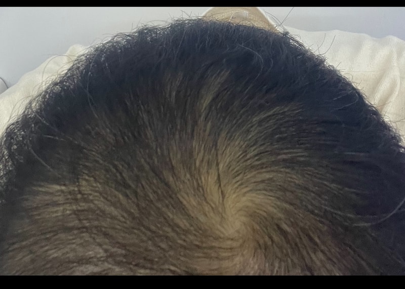 탈모3.PNG